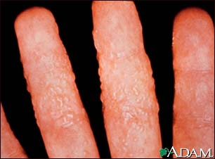 Dermatitis, reaction to tinea