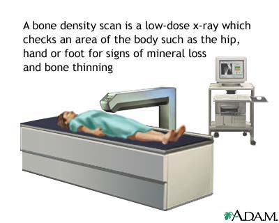 Bone density scan Bone density scan