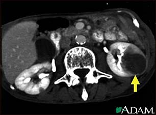 Kidney metastases, CT scan Kidney metastases, CT scan