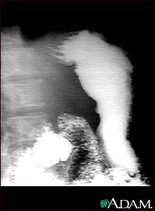 Stomach ulcer, X-ray Stomach ulcer, X-ray