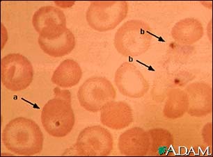 Malaria, photomicrograph of cellular parasites Malaria, photomicrograph of cellular parasites