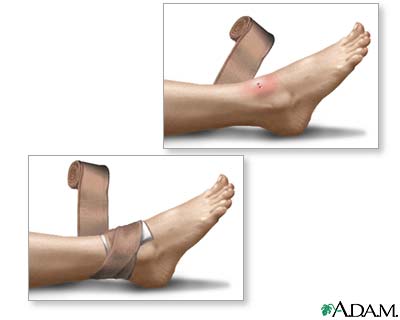 Indications Indications