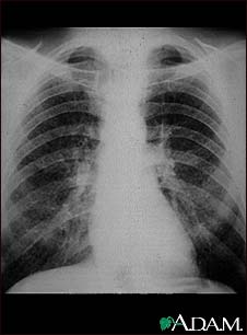Coal worker's lungs - chest X-ray Coal worker's lungs - chest X-ray