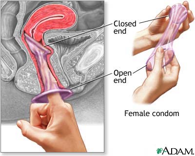 The female condom The female condom