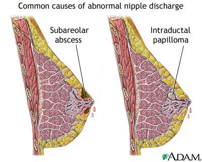 Abnormal discharge from the nipple Abnormal discharge from the nipple