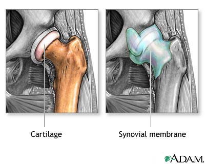 Osteoarthritis vs. rheumatoid arthritis Osteoarthritis vs. rheumatoid arthritis