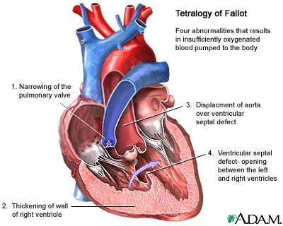 Tetralogy of Fallot Tetralogy of Fallot