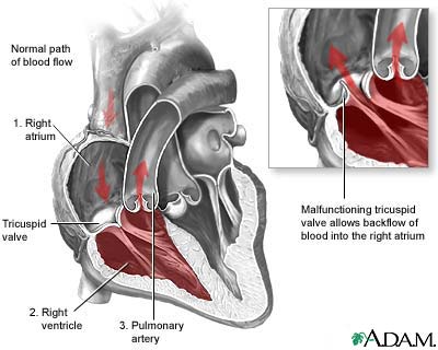Tricuspid Regurgitation Tricuspid Regurgitation