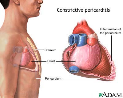 Constrictive pericarditis Constrictive pericarditis