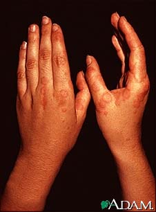 Erythema multiforme, circular lesions - hands Erythema multiforme, circular lesions - hands
