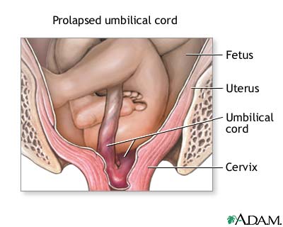 Complications of breech