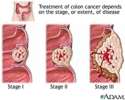 Stages of cancer Stages of cancer