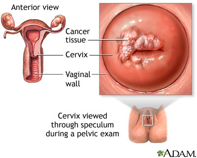 Cervical cancer Cervical cancer