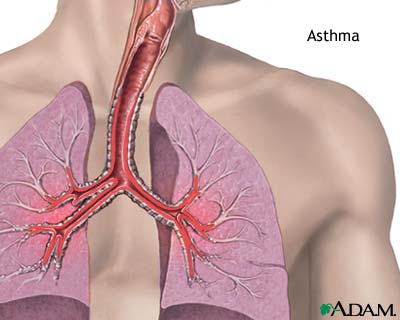 Asthma Asthma