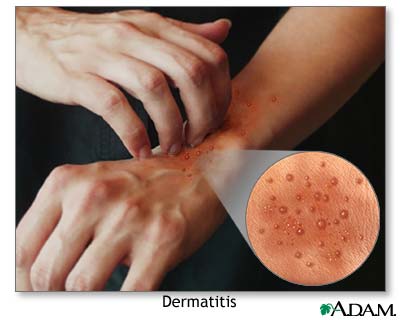 Atopic dermatitis Atopic dermatitis