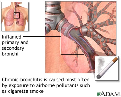 Cause of chronic bronchitis Cause of chronic bronchitis