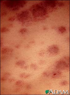 Acute Monocytic Leukemia - Skin Acute Monocytic Leukemia - Skin