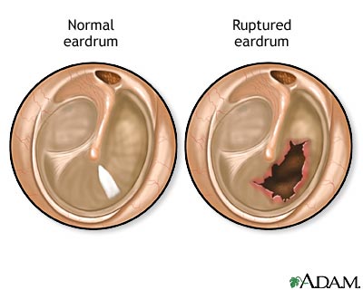Ruptured eardrum Ruptured eardrum