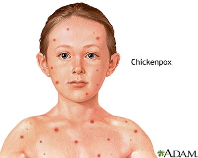 Chickenpox Chickenpox