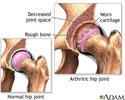 Arthritis in hip Arthritis in hip