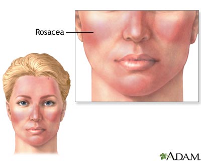 Rosacea Rosacea