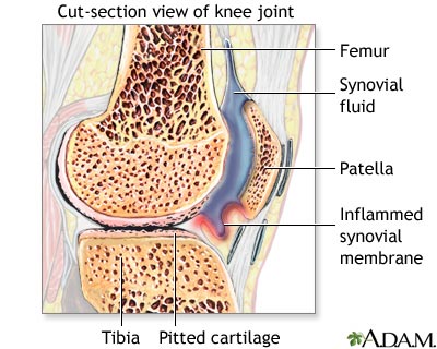Rheumatoid arthritis Rheumatoid arthritis