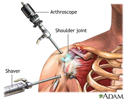Shoulder arthroscopy Shoulder arthroscopy