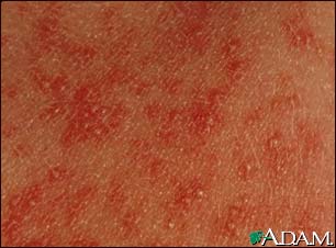 Erythema toxicum neonatorum - close-up