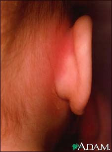 Mastoiditis - redness and swelling behind ear Mastoiditis - redness and swelling behind ear