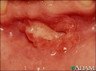 Canker sore (aphthous ulcer) Canker sore (aphthous ulcer)