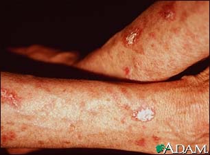 Actinic keratosis on the forearms Actinic keratosis on the forearms