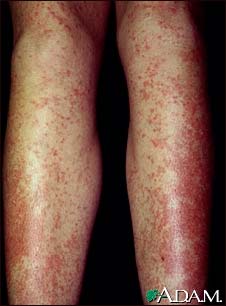 Drug rash, Tegretol Drug rash, Tegretol