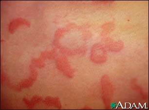 Hives (urticaria) - close-up