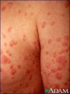Psoriasis, guttate on the arms and chest
