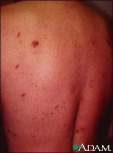 Kaposi's sarcoma on the back Kaposi's sarcoma on the back