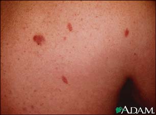 Kaposi's sarcoma - close-up Kaposi's sarcoma - close-up