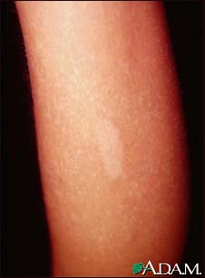 Tuberous sclerosis, hypopigmented macule Tuberous sclerosis, hypopigmented macule