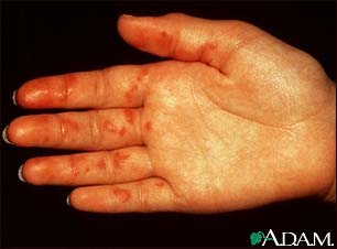 Vasculitis on the palm