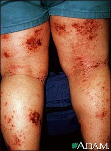 Dermatitis, atopic on the legs Dermatitis, atopic on the legs