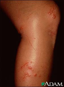 Poison ivy on the leg