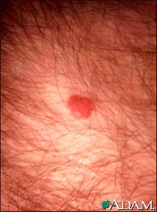 Kaposi's sarcoma - perianal Kaposi's sarcoma - perianal