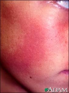 Keratosis pilaris rubra faceii