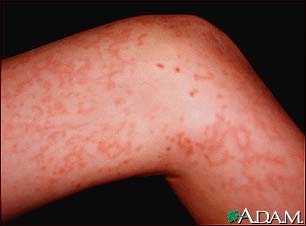 Wegener's granulomatosis on the leg