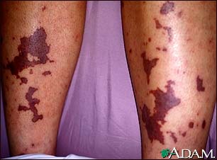 Meningococcemia on the calves Meningococcemia on the calves