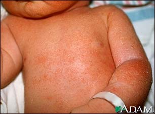 Miliaria crystallina - chest and arm Miliaria crystallina - chest and arm