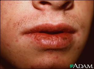 Cheilitis, actinic Cheilitis, actinic