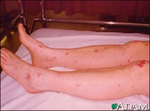 Meningococcemia associated purpura Meningococcemia associated purpura