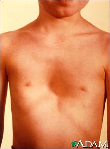 Pectus excavatum Pectus excavatum