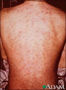 Drug rash on the back