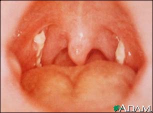 Mononucleosis - view of the throat Mononucleosis - view of the throat